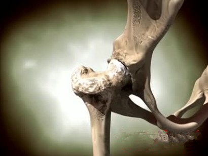 股骨头坏死保髋手术能用一辈子吗,股骨头坏死保髋手术恢复姿势视频