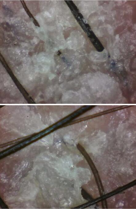 头皮屑多到底怎么回事,女人头皮屑多怎么回事