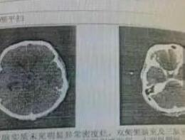 深圳男子被食脑虫入侵死亡,深圳男子被罕见食脑虫入侵