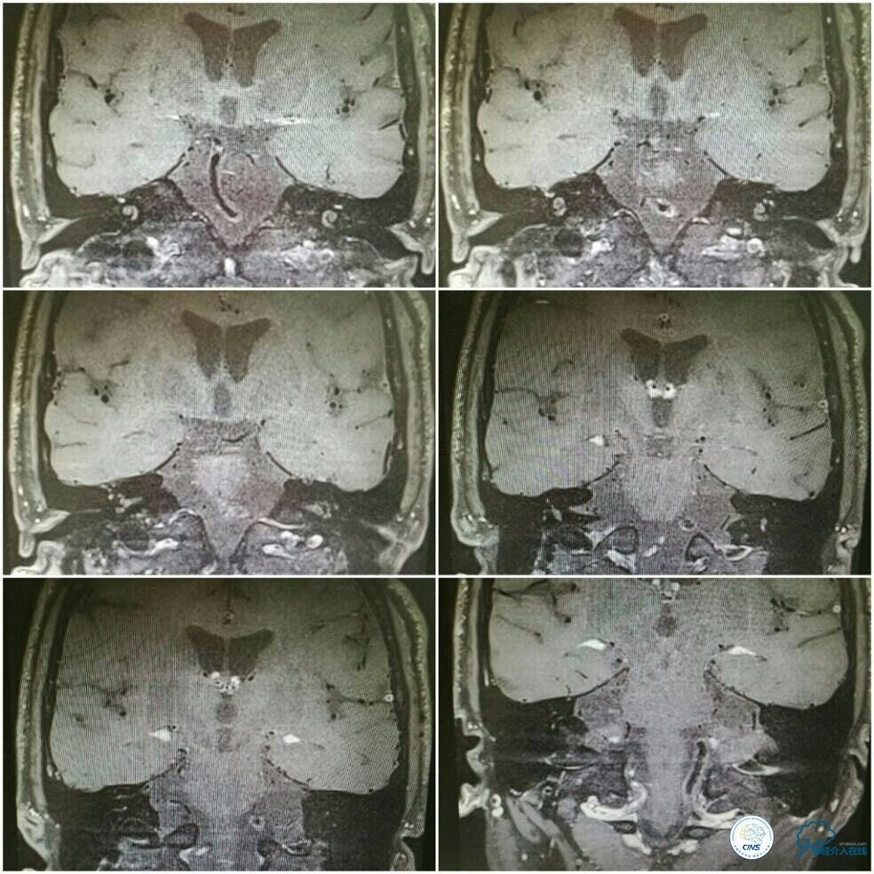 天坛周记|左椎V4段-基底动脉交界区狭窄的支架治疗