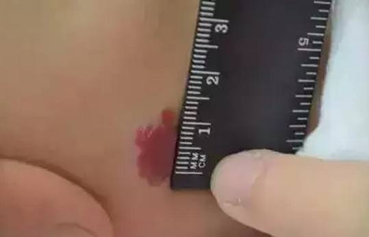 宝宝身上有哪些胎记,有胎记的小孩儿是不是天使