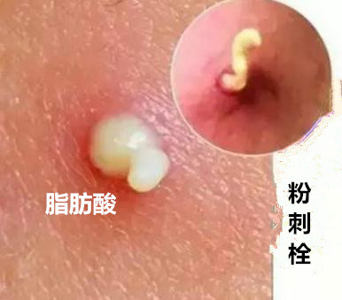 挤痘有刺痛感,挤痘为什么会留痘坑