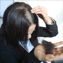 头发出油出头皮屑怎么办,头发出油有头皮屑掉头发