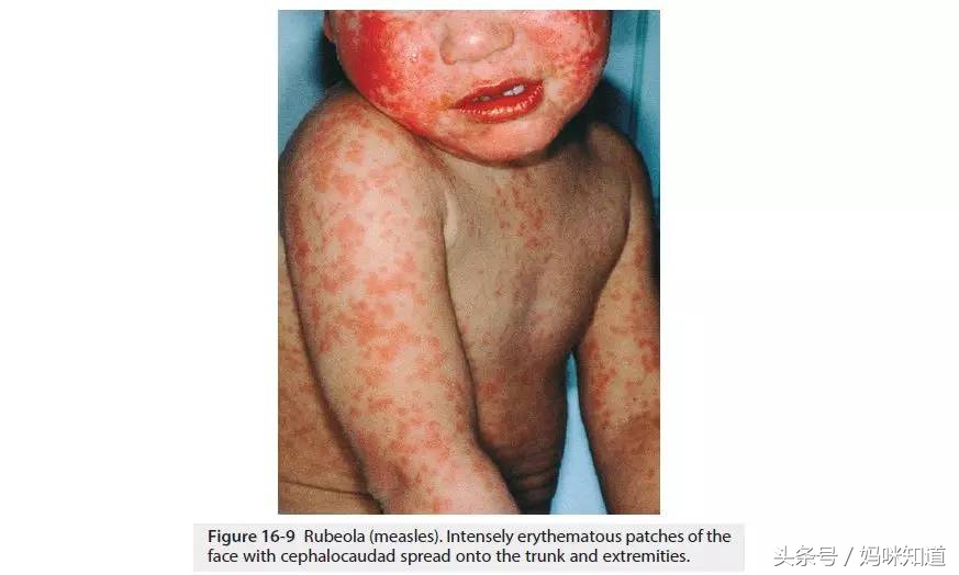 香港麻疹预防,香港麻疹病症