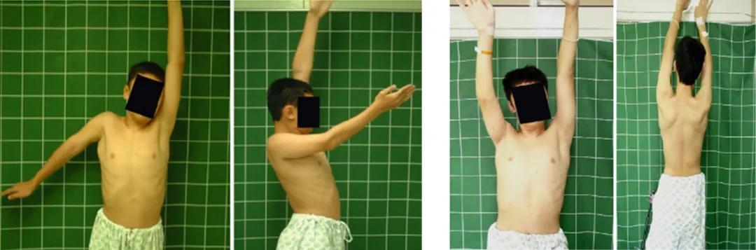 小儿骨科矫正足内翻,宝宝足内翻矫形支具