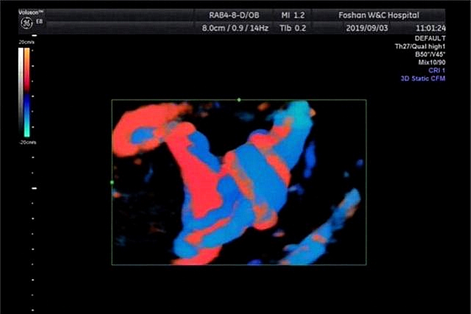 孕期16周脐带打结,孕妇怎么避免胎儿脐带打结