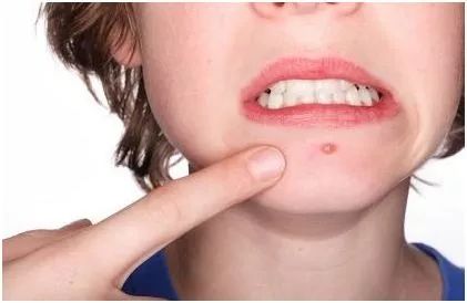 挤痘进了ICU，连下两次病危通知？这痘痘到底还能不能挤！