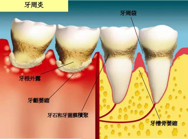 牙齿松了可以做补齿吗,牙松了用冷酸灵能固齿