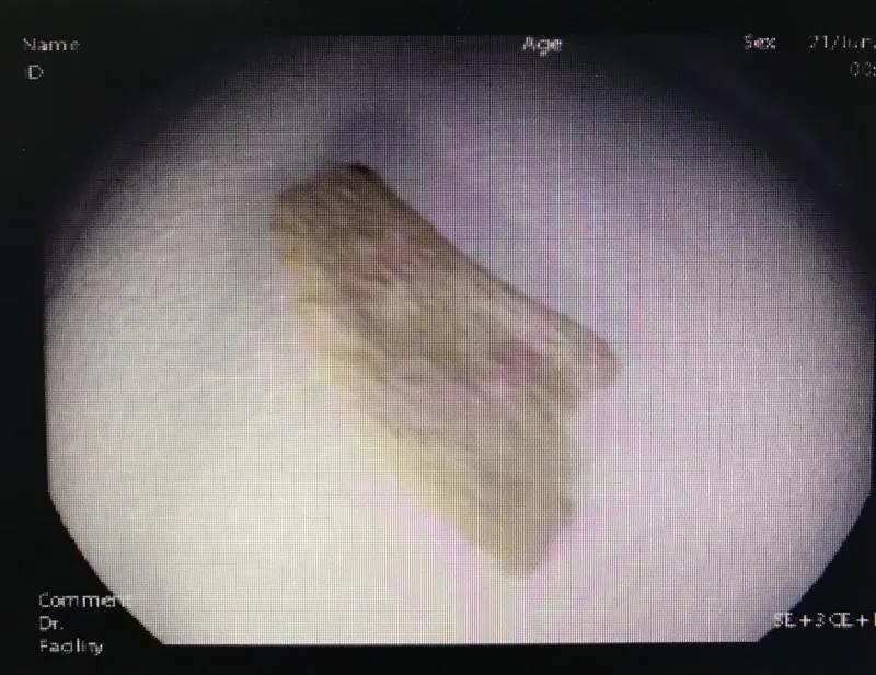 吃鸭脖被骨头卡住了怎么办,鸭头骨头卡食管