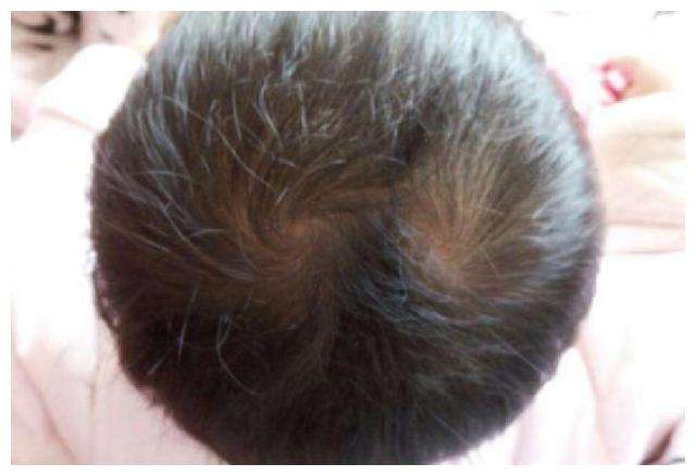 头上旋的位置有什么说法,头上的旋看下一胎准吗