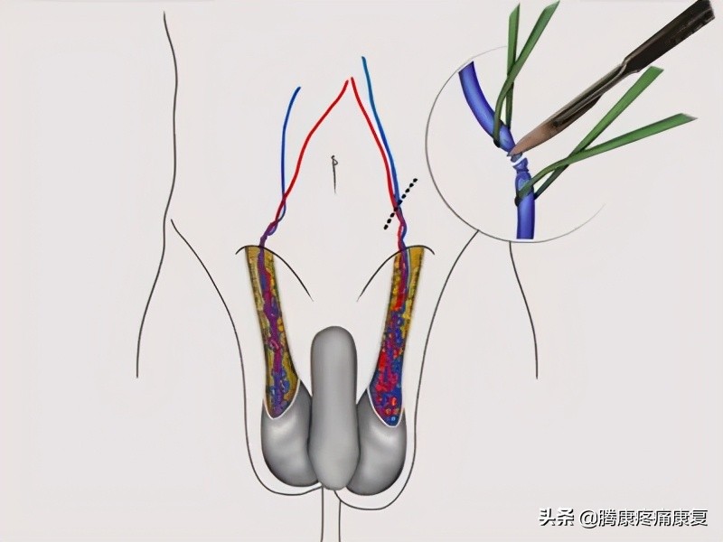 男性不育精索静脉曲张好治吗,精索静脉曲张性男性不育诊断标准