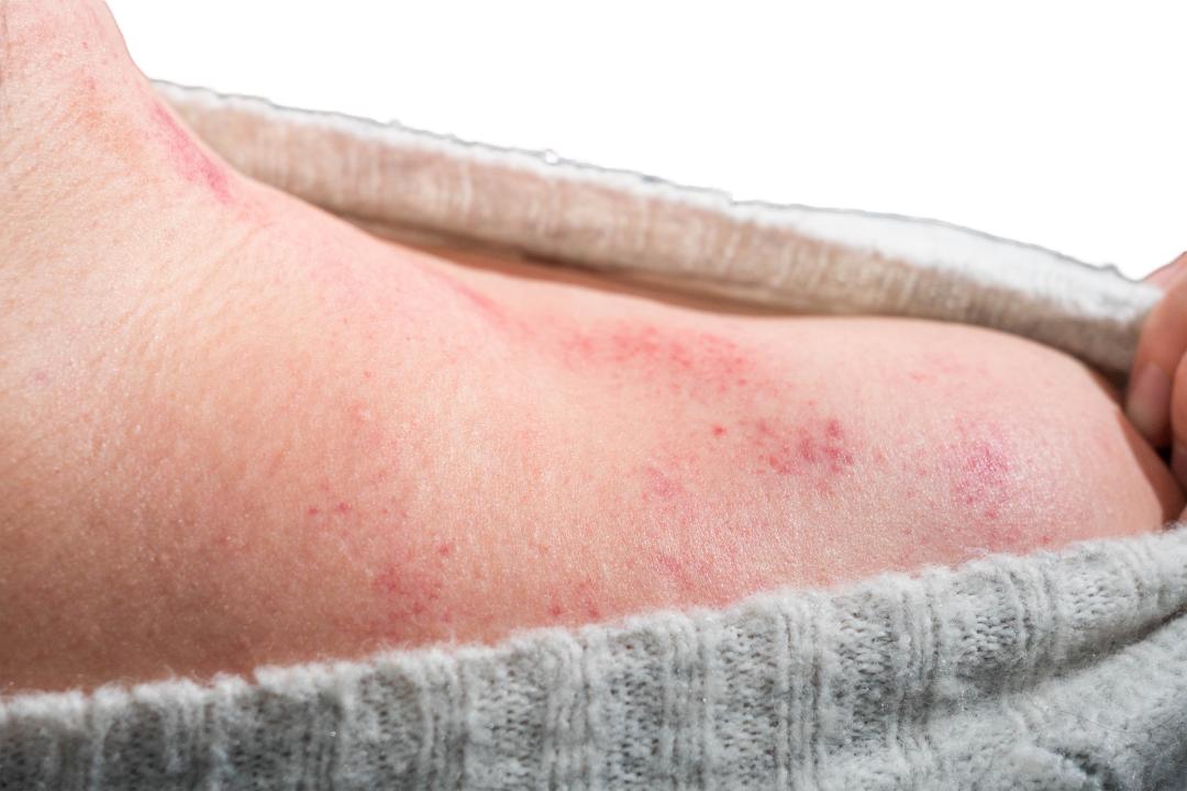 出痧有颗粒是怎么回事,出痧后有瘀青怎么办