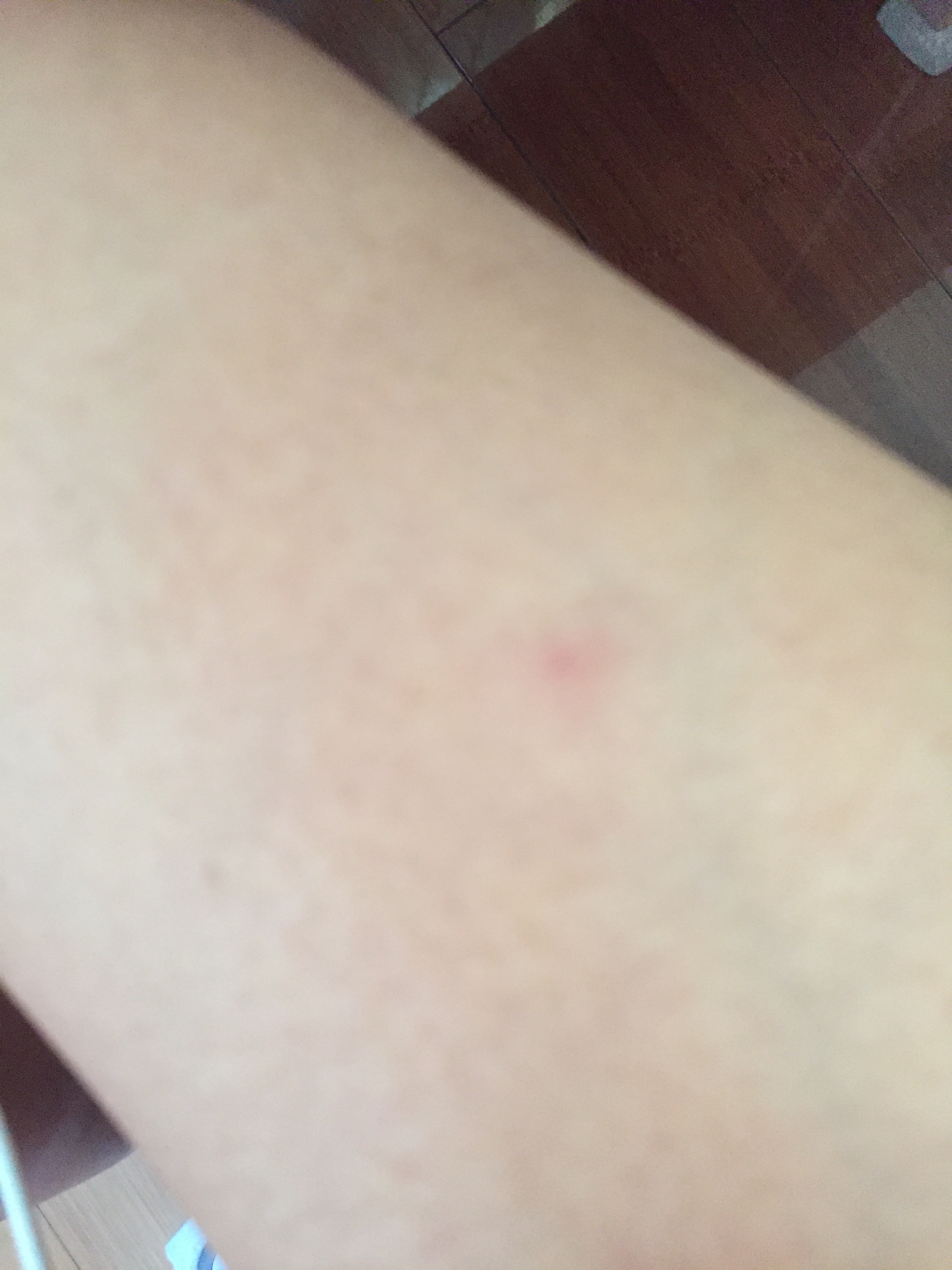 两个多月的婴儿被蚊子咬了怎么办,如果被蚊子咬了一口怎么办