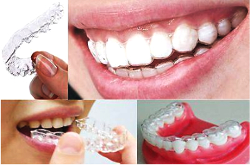 戴牙套戴哪种牙套最好,金属牙套与陶瓷牙套的优缺点