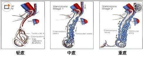 什么情况下精索静脉曲张才需要做手术