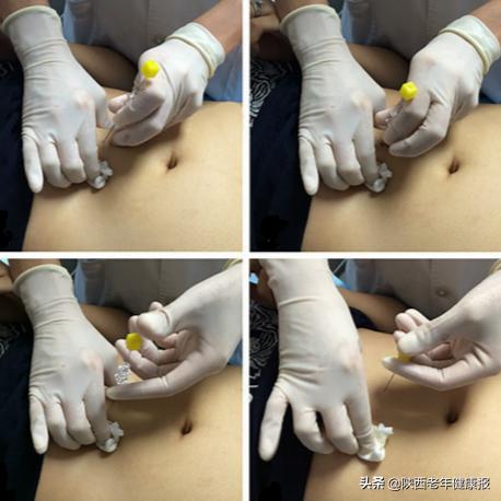 健康经络减肥,健康养生疏通经络减肥