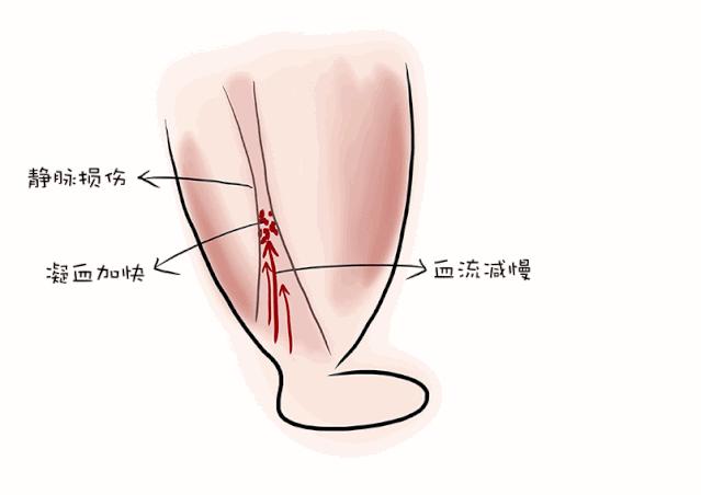 孕妈预防秘籍,孕妈防止血栓按摩腿部