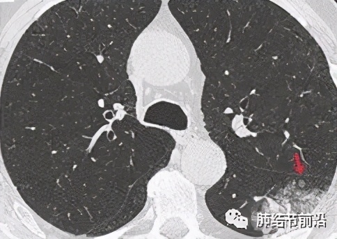 肺癌气道播散转移的症状,肺癌胸膜腔转移