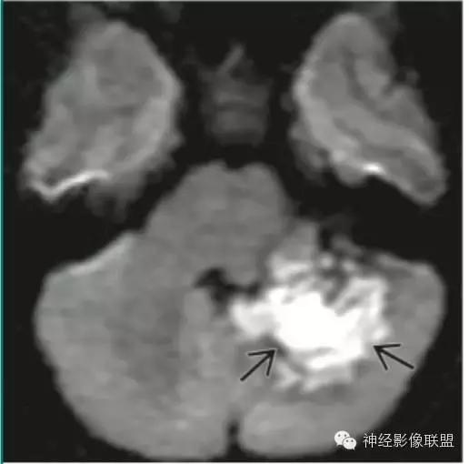 各种囊肿的症状,颅内囊肿18-19mm严重吗