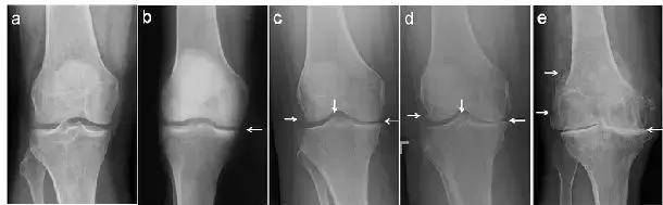 滑膜炎是不是炎症,骨质增生膝盖疼痛膝盖积液滑膜炎