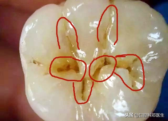 比一般人更容易蛀牙什么原因,长蛀牙的现象有哪些