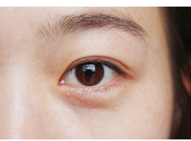 眼白里面有黑痣是怎么回事,眼白处有颗黑痣能不能去掉