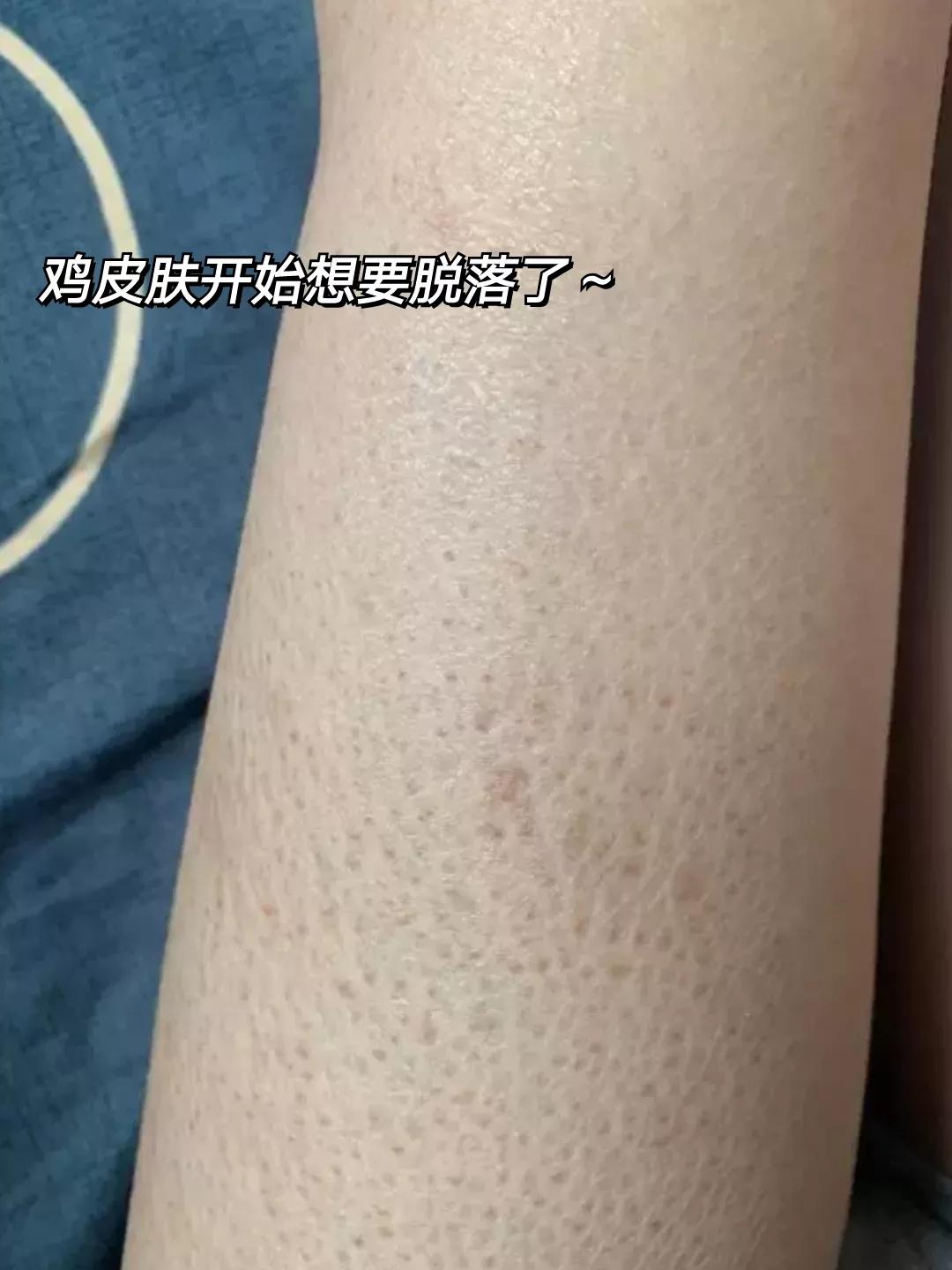 新手去鸡皮方法！皮肤一天比一天滑溜