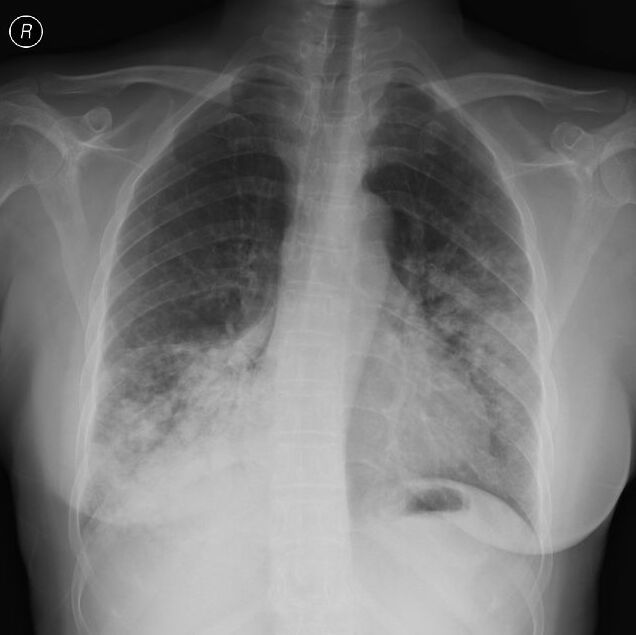 黏液腺癌基本不转移不复发,肺粘液腺癌转移了还能治好吗