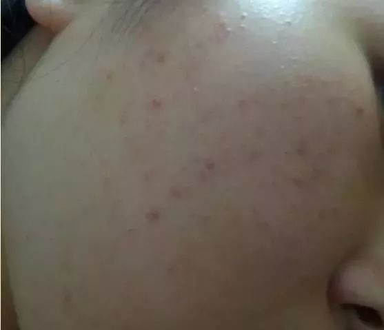 祛除闭合性粉刺软膏有哪些,下巴有闭合性粉刺怎么祛除