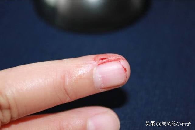 人受伤后伤口怎么愈合?显微镜放大100倍,看完长见识了