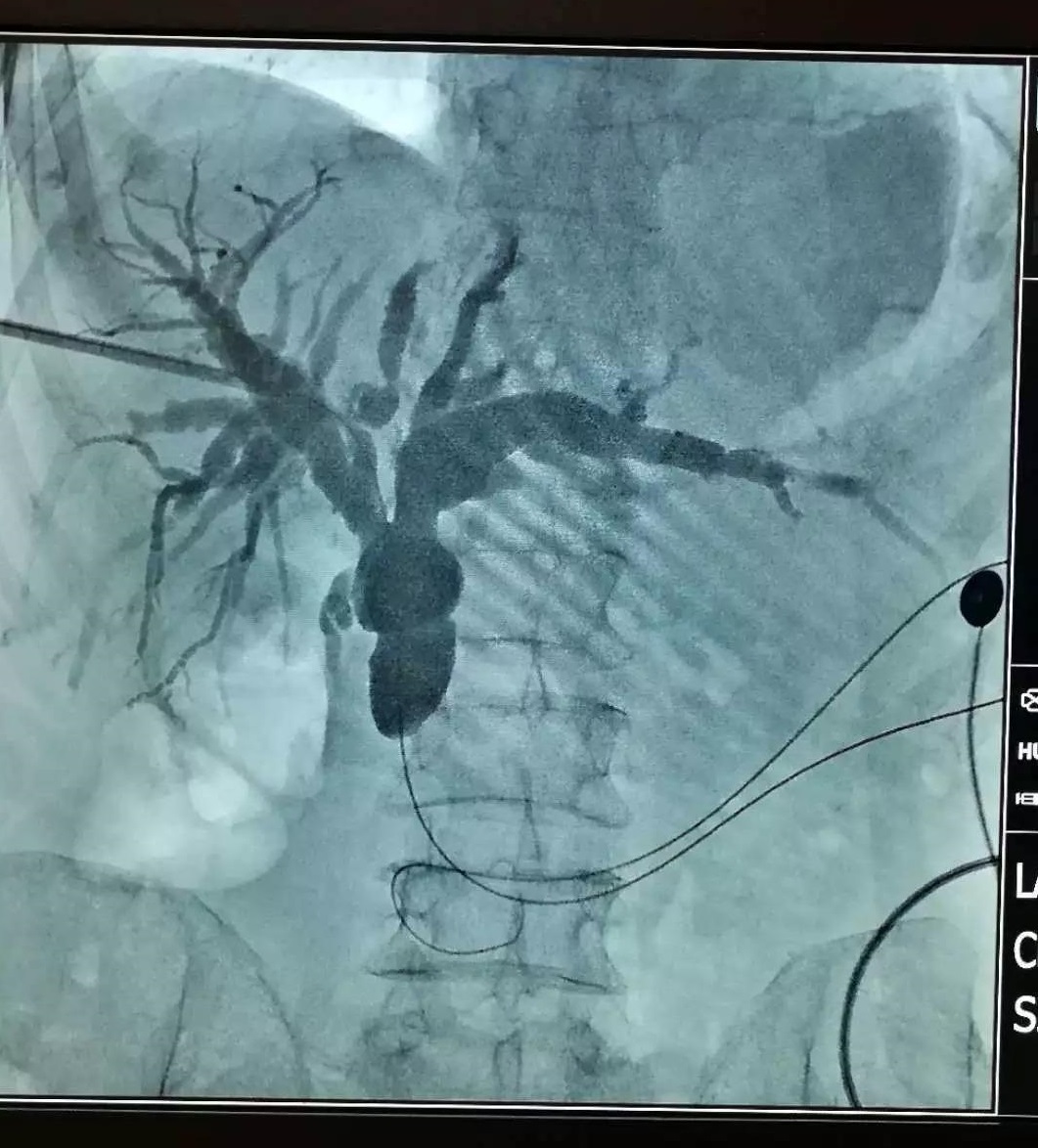 胆肠吻合术后胆瘘怎么处理,胆肠吻合口狭窄术后还会复发吗