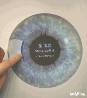 近视眼激光手术后20年后的后遗症,权威讲解近视眼手术的利弊