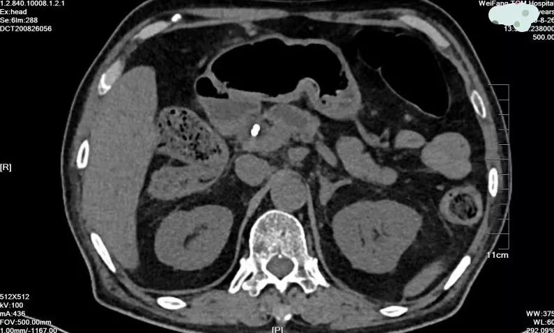 老年人肠梗阻疼痛难忍,老年人腹部剧痛