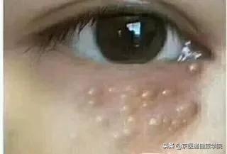 粟丘疹汗管瘤扁平疣区别,粟丘疹和汗管瘤区别