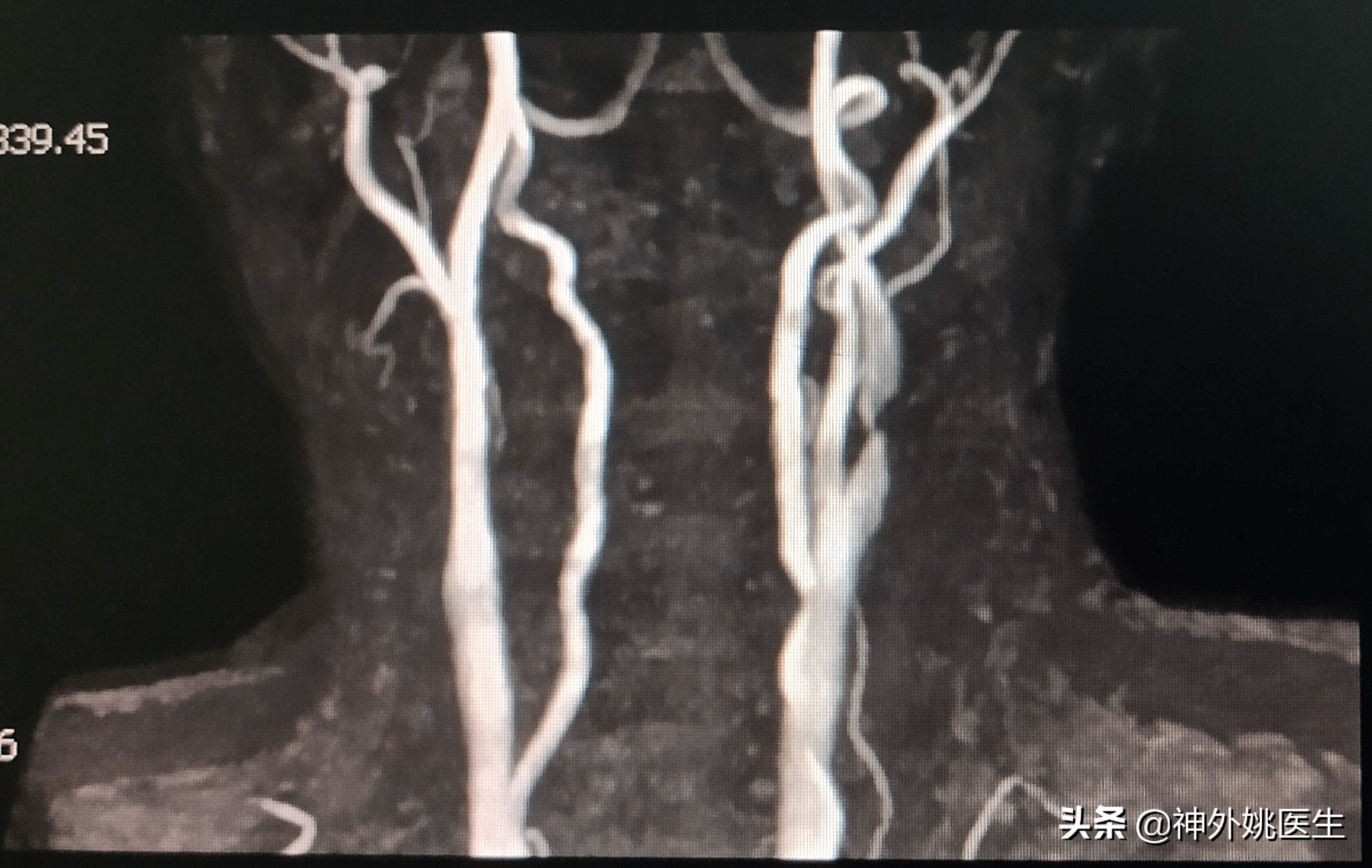 颈动脉狭窄的外科治疗