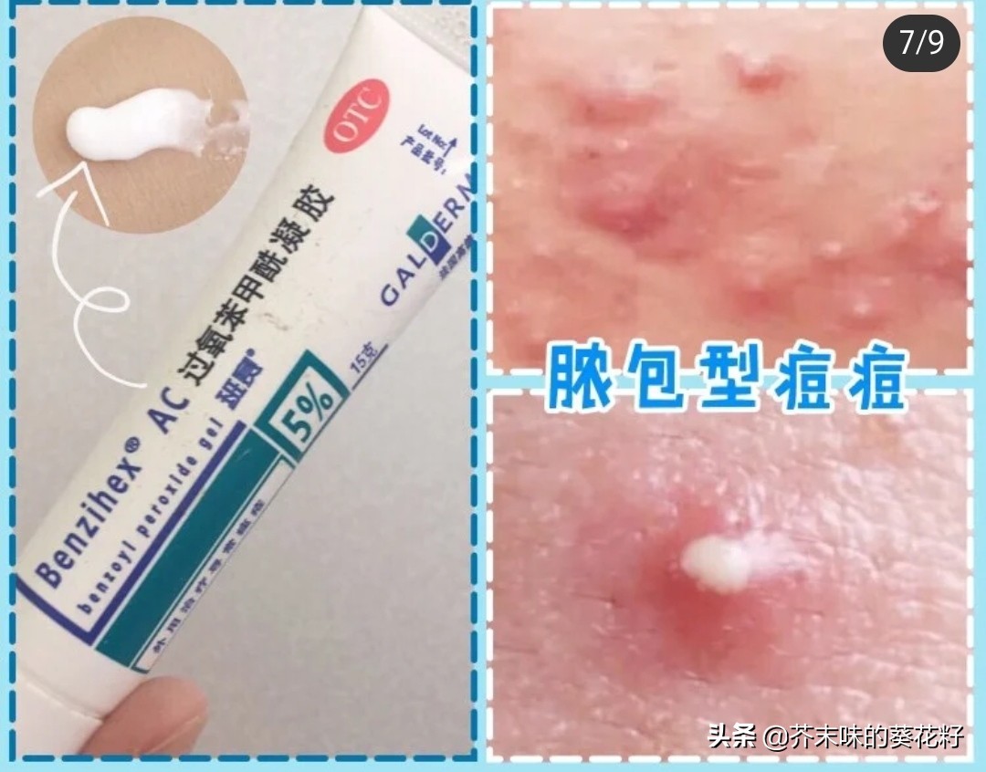 不同部位痘痘消除方法小学生,不同类型的痘痘的祛痘方法