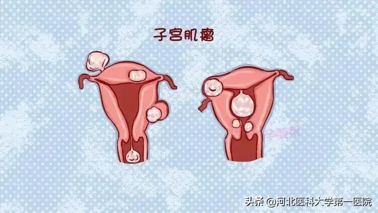 子宫炎症微创手术全过程,切除子宫是微创好还是别的办法好