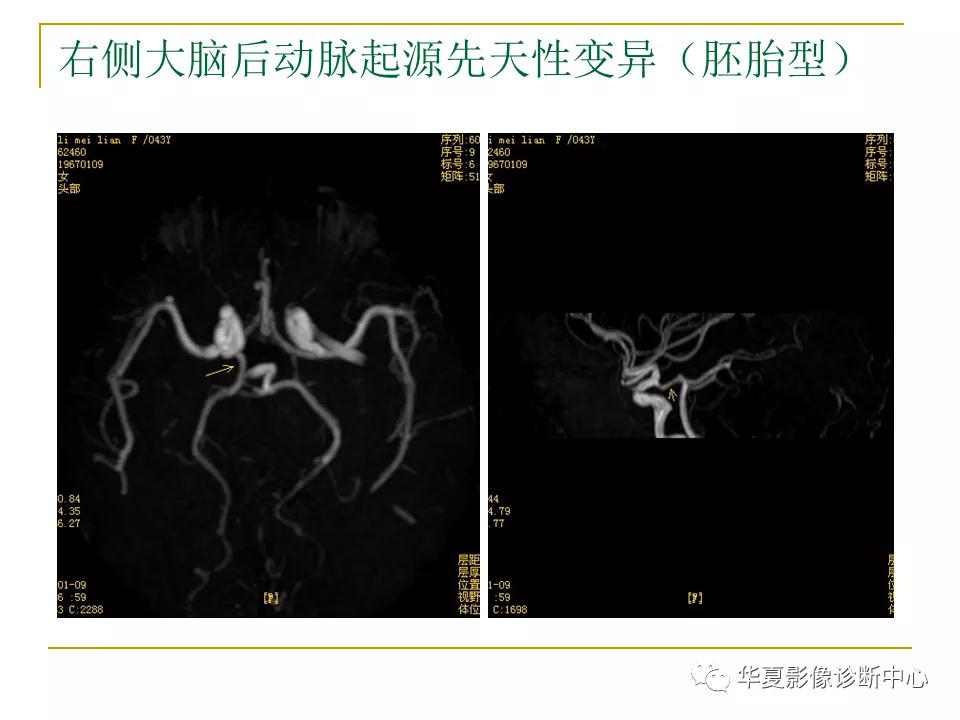 中国人脑立体定向mri应用解剖图谱,脑mri示意图