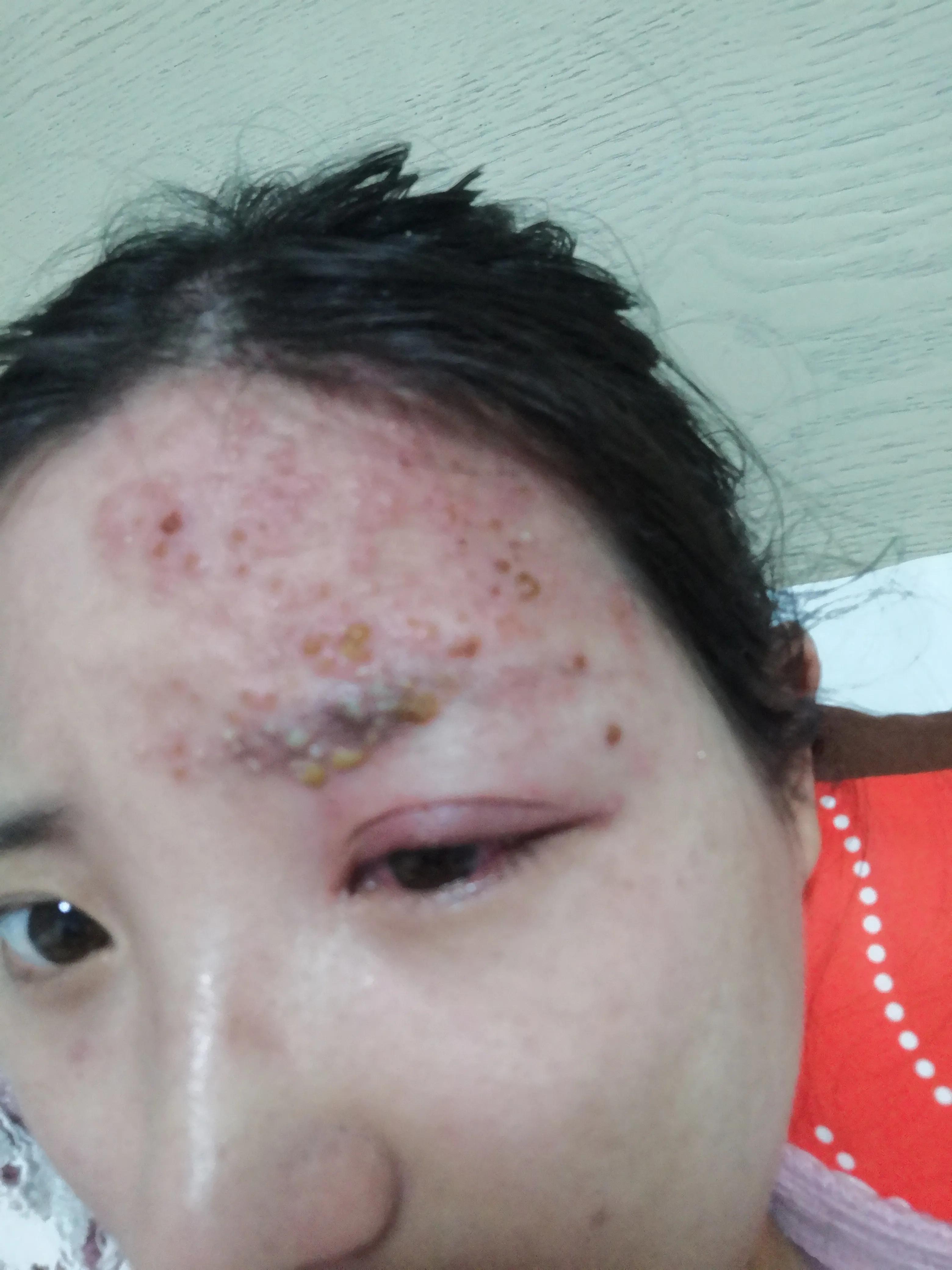 孕妇得了带状疱疹病毒怎么办,孕中期得带状疱疹该怎么办