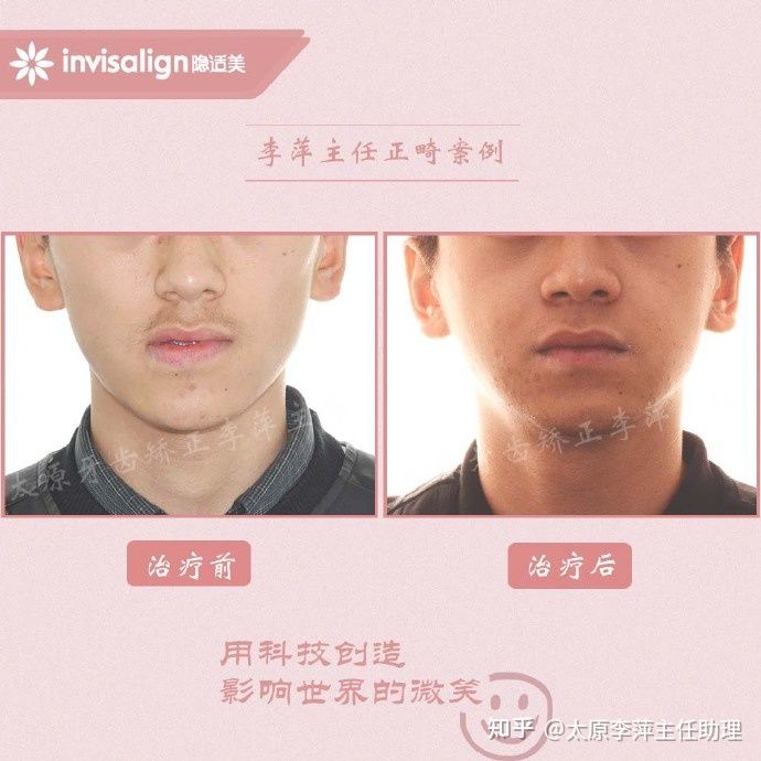 重度拥挤矫正牙齿适合隐形牙套吗,广州成人牙齿矫正推荐隐形牙套