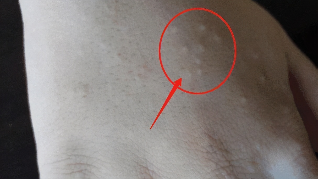 热天手上长汗疱疹怎么回事,天气热身上起汗疱疹