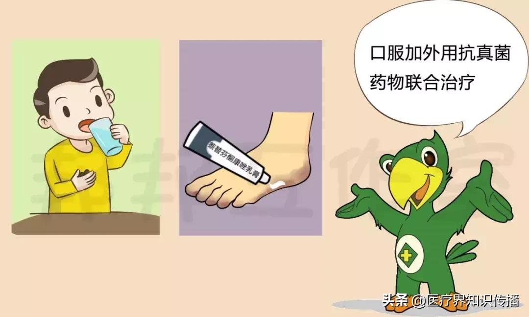 脚气怎么不用药治疗,鳞屑角化型脚气可以彻底治愈吗
