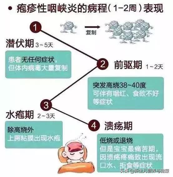 疱疹性咽峡炎可以不用吃药吗,疱疹性咽峡炎用什么药可以预防