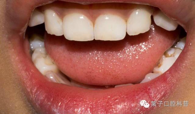 小孩可以洗牙视频,儿童可以洗牙吗洗牙的过程是什么