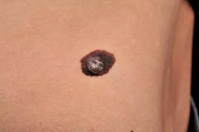 痣能点吗,我的痣凸起来会癌变吗