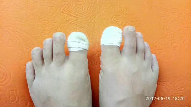 摆脱甲沟炎的痛苦之后的感想,甲沟炎的亲身经历