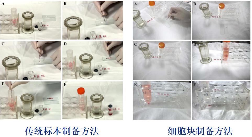 支气管镜高频电刀治疗中央型肺癌,支气管镜在早期肺癌诊断的意义