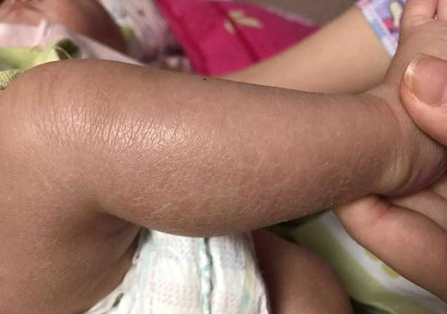 宝宝身上鱼鳞状皮肤,宝宝5个月了身上像鱼鳞怎么回事