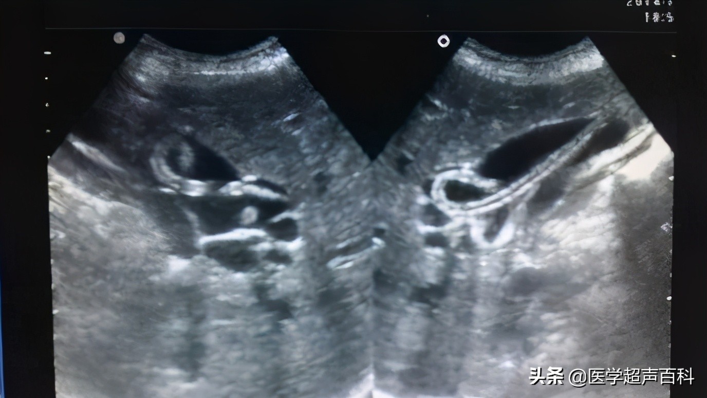 胆道蛔虫病超声表现,超声诊断胆囊疾病图像