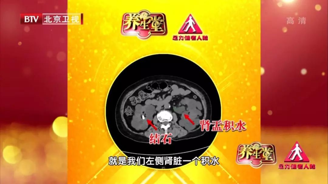 肾结石引起肾积水做个倒立能通吗,肾结石倒立能排出多大的结石